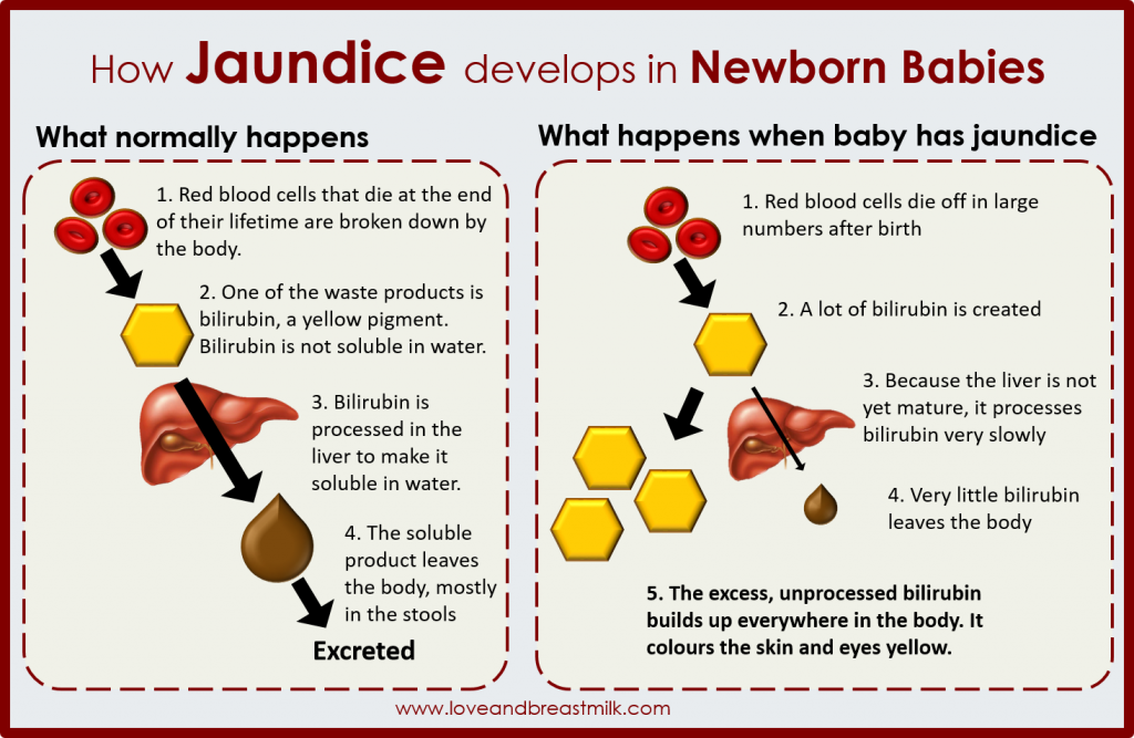 jaundice-in-breast-fed-babies-love-and-breast-milk